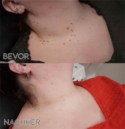 1 + 1 Gratis | BeeVenom™ Schmerzfreie Hauterneuerung [Letzter Tag Rabatt]