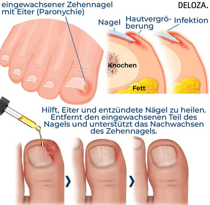 NailHeal™ - Reparatur beschädigter Nägel in 4 Wochen [1 + 1 Gratis]