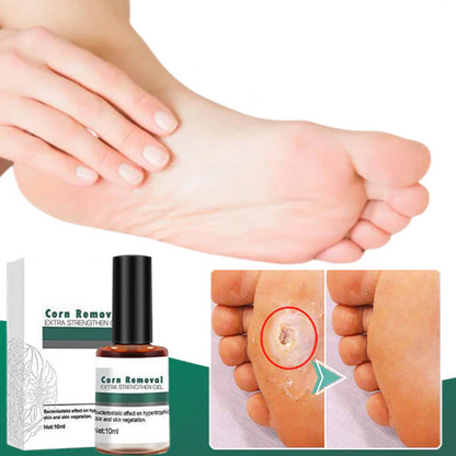 CallusClear™ – Effektiver Hühneraugen- & Hornhautentferner mit extra starkem Linderungsgel [1 + 1 Gratis]