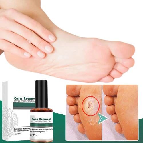 CallusClear™ – Effektiver Hühneraugen- & Hornhautentferner mit extra starkem Linderungsgel [1 + 1 Gratis]