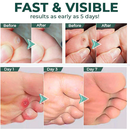 CallusClear™ – Effektiver Hühneraugen- & Hornhautentferner mit extra starkem Linderungsgel [1 + 1 Gratis]